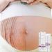 Best Stretch Mark Cream for Pregnancy & Postpartum - Repair & Remove Scars - Buy Online on GoSupps.com