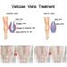 Varicose & Spider Veins Cream for Legs - Improve Blood Circulation, Varicose Care Ointment (50g) - Buy Online on GoSupps.com