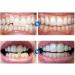 Set of 5 Transparent Mouth Guards for Teeth Grinding - Night Guard for Sleep Support - Buy Online on GoSupps.com