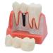 Dental Implant Model - 4 Times Removable Analysis Crown Bridge Demonstration Teeth Model Dental Implant Analysis Tooth Model for Learning and Education