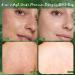 Salicylic Acid Scrub Soap - Acne Cleanser & Dark Spot Treatment with 8 Active Ingredients | Brightening Kojic Bar Soap for Blemish & Sun Spot Removal - Buy Online on GoSupps.com