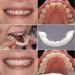 Cryfokt 6 Set False Braces | Temporary Silicone Veneers for Missing Teeth | Snap-In Denture Teeth Coverage - Buy Online on GoSupps.com