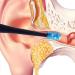 Waitlover Ear Wax Removal Kit - Ear Pick Cleaning Tool for Healthier Ears - Buy Online on GoSupps.com
