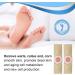 Wart Removal Plasters 24Pcs - Hands & Feet Corn Remover with Hole Plantar Warts Callus - Stops Regrowth - Effective Wart Treatment - Buy Online on GoSupps.com