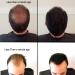 Samson Keratin Hair Loss Fibers - Black 25g Refillable Container Hair Loss Concealer - Made in USA - Buy Online on GoSupps.com