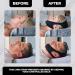 Dysnosis Chin Strap - Anti Snore Cpap Chin Strap for Men and Women - Buy Online on GoSupps.com