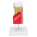Verdant Touch Tooth Model Dental Caries Tooth Model for Teaching Training Patient Education