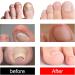 Ingrown Toenail Treatment Ingrowing Toenail Treatment Nail Growth Treatment Natural Ingrown Toenail Correction Nail Treatments Trimming Toenail Softening Drops Toe Nail Fungal Treatment(10ml) - Buy Online on GoSupps.com