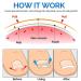 Glue-Free Ingrown Toenail Corrector Patch - 50 Pcs | Treatment Tool for Ingrown Toenails - Buy Online on GoSupps.com