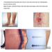 Premium Compression Stockings for Varicose Veins | Open Toe & Calf Support Socks for Men & Women | Enhance Weight Loss & Thrombosis Relief - Buy Online on GoSupps.com