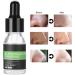Qukaim Blackhead Liquid Blackhead Shrinkage Essence Export Liquid 10ml Deep Cleansing Blackhead Removal Set - Buy Online on GoSupps.com