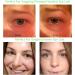 Natural Ultra Invisible One-Sided Eyelid Tape for Instant Eyelid Lift - Ideal for Hooded, Droopy, or Uneven Eyes - Buy Online on GoSupps.com