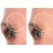 SiO Beauty BrowLift Forehead Anti-Wrinkle Patch - Rapid Overnight Reusable Silicone Patch to Reduce Furrows Expression Lines and Creases - Buy Online on GoSupps.com