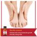 Mycose Ongles Des Pieds Lopsx Traitement Mycose Ongle Pied Puissant - Traitement Efficace pour Ongles Ab m s D color s et Fragiles 10ml - Buy Online on GoSupps.com