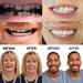 Zhirceke Temporary Dental Prostheses - Repair Your Smile Fast | Upper & Lower Jaw Solutions - Buy Online on GoSupps.com