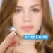 AVJONE Day and Night Hydrocolloid Acne Pimple Patch - 108+36 Vegan-Friendly Spot Stickers for Face and Skin - Buy Online on GoSupps.com