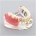 Dental Upper Implantate Model - Superior Overdenture Restoration for Education | Transparent Vision & Soft Gum - Ideal Study Tool - Buy Online on GoSupps.com