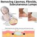 Lipoma Removal Cream Cr me d' limination de lipomes Cellulite Removal Exfoliating Cream Get Rid of Your Fatty Lipoma Lumps (2pcs) - Buy Online on GoSupps.com