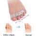 Bunion Corrector Toe Separators - 2 Pairs Silicone Gel Toe Straighteners for Overlapping Toes, Hallux Valgus, and Foot Pain Relief - Men and Women - Buy Online on GoSupps.com