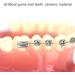 Dytah 1:1 Orthodontic Treatment Teeth Model - Patient Communication & Teaching Tool with Metal & Ceramic Brackets for Adults - Buy Online on GoSupps.com