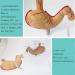 Educational Model Simulated Human Stomach Anatomy Model Diseased Stomach Model Stomach Disease Demonstration Model Pathological Stomach Model Medical Models - Buy Online on GoSupps.com
