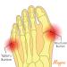 Alayna Bunion Corrector - Non-Slip Orthopedic Protector for Bunion Pain Relief - Small Size (2 PCS) - Buy Online on GoSupps.com
