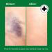 Miracle Plus Natural Arnica Bruise Body Gel - Extra Strength Vitamin K Cream for Bruising Swelling & Thin Skin - 4 Oz Arnica Ointment for Post-Surgery Skin Care - Buy Online on GoSupps.com