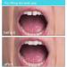 Womcare Temporary Tooth Repair Kit - Fill Missing/Broken Teeth & Gaps - Moldable Fake Teeth Replacement with Thermal Beads - Buy Online on GoSupps.com
