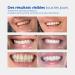 PROFESSIONAL SENSITIVE Teeth Whitening Strips - 14 Gentle Teeth Whitening Applications Peroxide and Acid Free - Made in Spain - Reduces up to 6 Shades in 4 Weeks - Buy Online on GoSupps.com