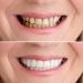 Asiacreate Temporary Dentures Kit - Customizable Smile Teeth Veneers - Buy Online on GoSupps.com