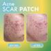 Fazit Acne Scar Treatment Patches - 24 Individual Patches for Face Bikini & Body - Effective Acne Scar Remover - Buy Online on GoSupps.com