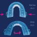 SmartGuard Anti-Snoring Device: Custom Snore Stopper Mouthpiece for Men and Women - Adjustable Jaw Oral Appliance for Improved Sleep Quality - Buy Online on GoSupps.com