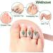 Welnove Toe Straightener Hammer Toe Corrector Pack of 2 - 3 Hole Splint for Claw Toe, Mallet Toe, Contracted Toe - Toe Straightener and Corrector for Improved Comfort and Alignment - Buy Online on GoSupps.com
