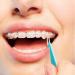 Buy INGJIA 10pcs Orthodontic Elastic Disposable Braces - Mixed Color - International Shipping Available - Buy Online on GoSupps.com