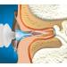 Mack's ProRinse Ear Wax Removal Syringe with Triple-Action Rinse Tip - Effective Ear Wax Removal Solution - Buy Online on GoSupps.com