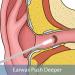 Ear Wax Removal Tool - Sleek Design for Small Ears | HT-P20 (US Plug) - Buy Online on GoSupps.com