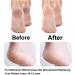 6 Pack Concave Shape Extra Coarse Roller Refills for Amope Pedi Electronic Foot File - Buy Online on GoSupps.com