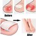 52 Pcs Ingrown Toenail Correction Strips Brace Kit Ingrown Toenail Corrector Toenail Correction Patches Ingrown Toenail Treatment Toenail Straightener Strips with Nail Clipper for Women Men Foot Care - Buy Online on GoSupps.com
