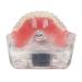 Dental Teeth Model - Lower Removable Overdenture with 2 Implants | Dentist Assistant Supplies - International Shipping - Buy Online on GoSupps.com