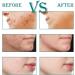 Star-Shaped Pimple Patch Small Hydrocolloid Acne Stickers Comfortable Acne Absorbing Cover Patch for Face Back Acne Dots Blemish Pimples Whiteheads 112 Patches - Buy Online on GoSupps.com