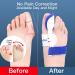 Bunion Corrector Splint Pads - Hallux Valgus Brace for Overlapping Toe - 2 Pair (BPA-Free) - Buy Online on GoSupps.com