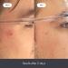 Hero Cosmetics Rescue Balm - Post Blemish Recovery Cream 15 ml | Soothes & Heals - Buy Online on GoSupps.com