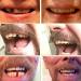 3-Part Temporary Dentures Set - Quick Tooth Replacement for Men & Women | Easy Thermal Repair Solution - Buy Online on GoSupps.com