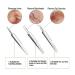 FEITA Blackhead Remover Kit - 5 Pcs Acne Tweezers & Extractor Set with Travel Case - Buy Online on GoSupps.com