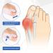 Bunion Corrector Kit - Gel Inserts for Pain Relief in Hallux Valgus Big Toe Separator for Men & Women - Improve Comfort & Foot Health - Buy Online on GoSupps.com