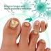 Kerassentials Toenail Fungus Treatment - Healthy Skin Solution (2 Pcs) - Buy Online on GoSupps.com