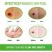 Memonotry Skin-Tag-Remover-Serum 30.00ml - Extra Strength Treatment for Skin Tags & Warts - Painless & Safe Removal - Pack of 1 - Buy Online on GoSupps.com