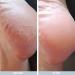 Cracked Heel Repair Cream 500ml | 25% Urea | Hard Skin Remover | Heel Balm for Dry Cracked Feet | Tea Tree Oil | Men & Women - 500.00 ml - Buy Online on GoSupps.com