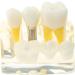 Implant Model Removable Bridge - Educational Teeth Model for Dental Studies | Perfect for Demonstration Classes - Buy Online on GoSupps.com