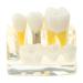 Implant model 4 times removable bridge demonstration class education and study teeth model bridge white